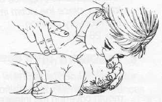 Infant Choking